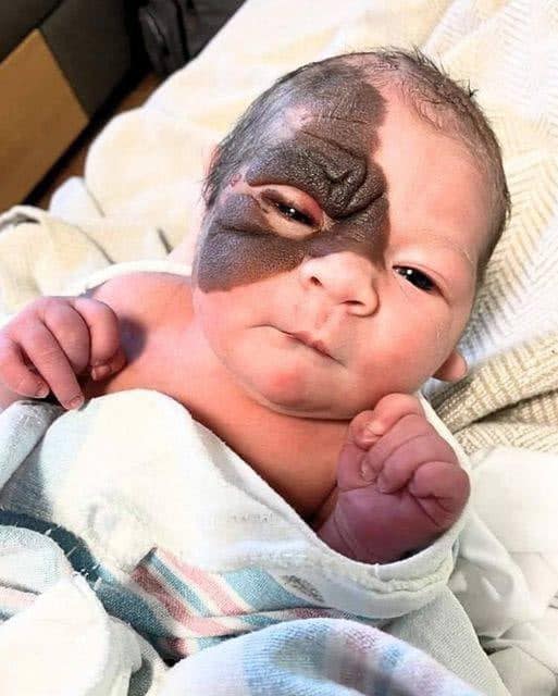 A mother wants to show her 13-month-old daughter, who has a rare birthmark, that she is beautiful just the way she is.