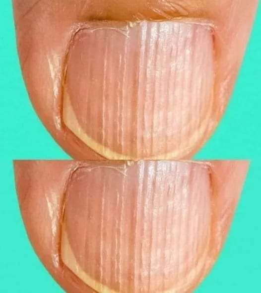 Having striped nails might be a sign that your body is…