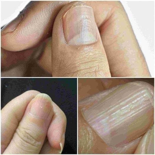 Understanding the Causes of Lines on Your Nails