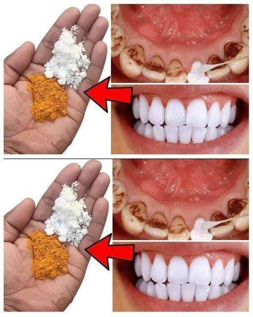 Natural Solutions Using Cloves and Bay Leaves for a Radiant Smile…