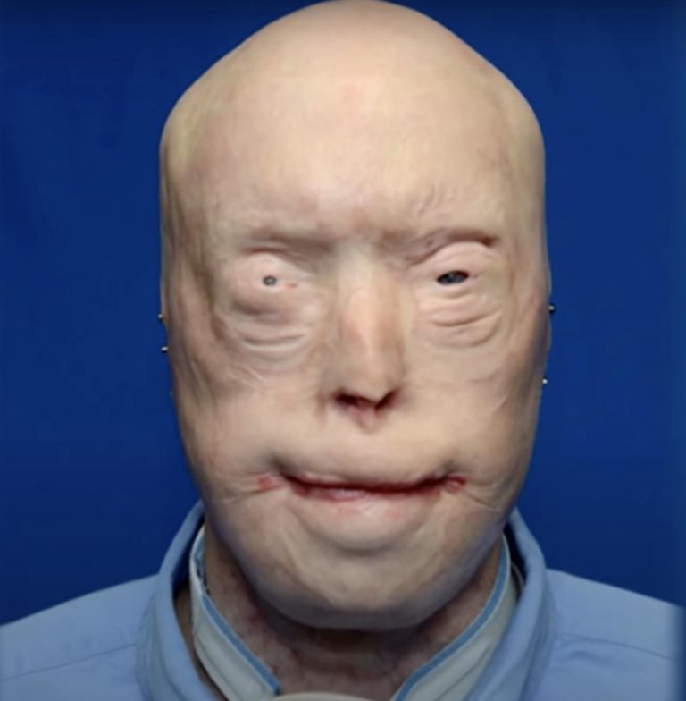 Firefighter Has Face Transplant After Third-Degree Burns & Survives Against All Odds – See Him Now, 7 Years Later