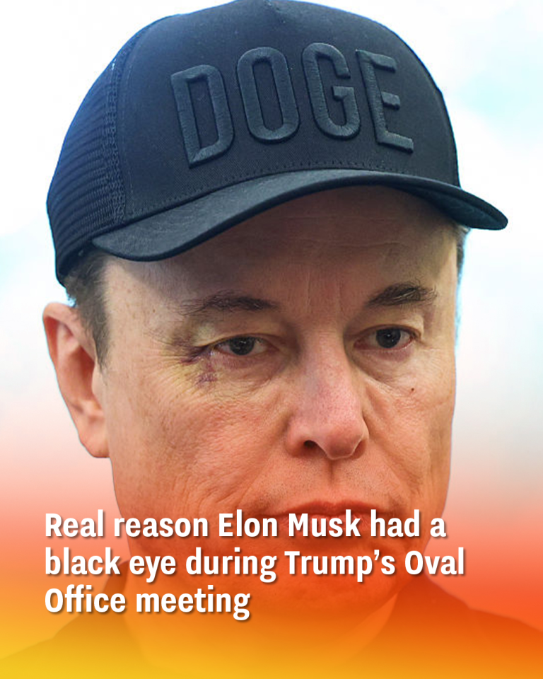 Real reason Elon Musk had a black eye