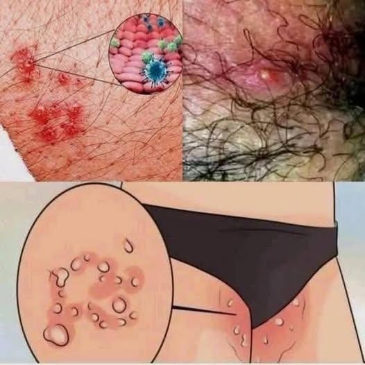 From Deep Wound to Recovery: The Healing Journey of a Severe Back Abscess