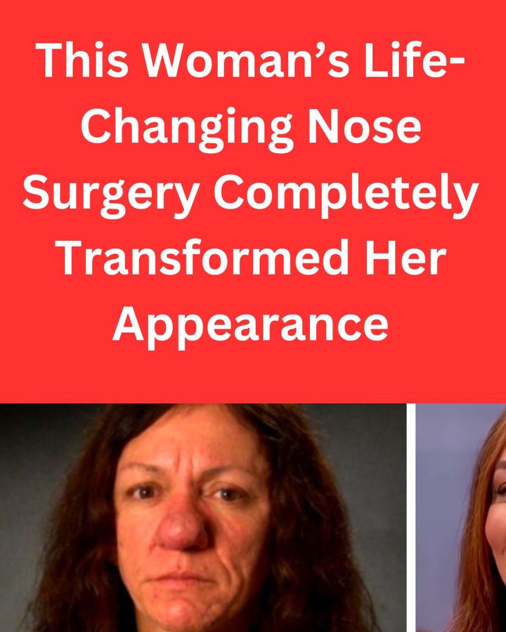 This Woman’s Life-Changing Nose Surgery Completely Transformed Her Appearance