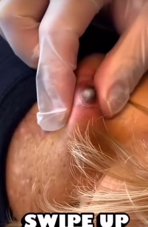 Their acne is severe