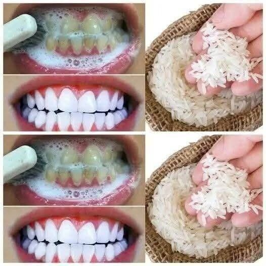 Natural Teeth Whitening – Say Goodbye to Yellowing and Tartar
