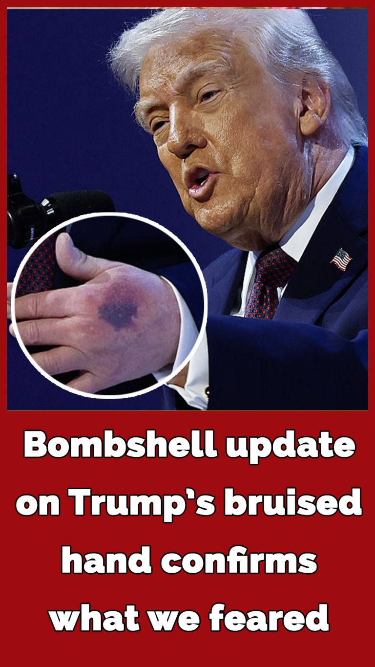 Trump explains the heavy bruise on his left hand came from ‘clipped it on the table’