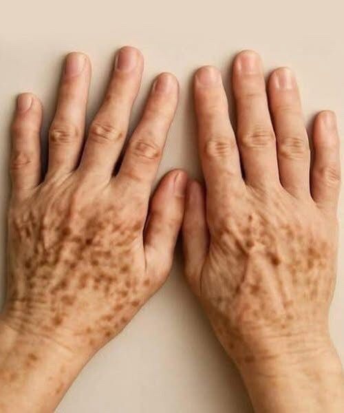 Did you know that if you get spots on your hands it means you have