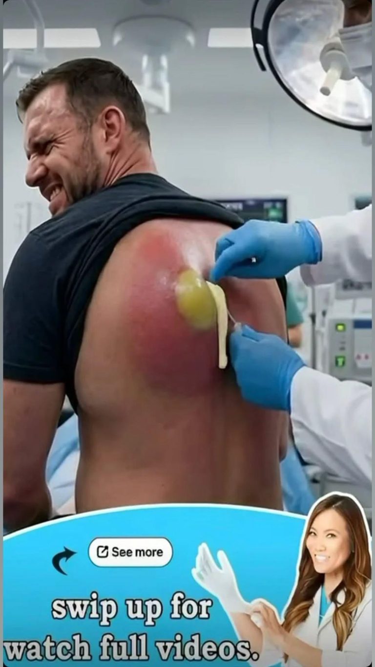 Their acne is severe