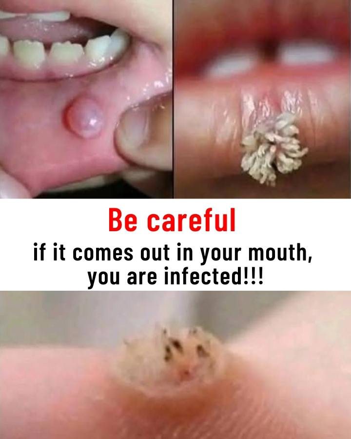 Be very careful if it comes out in your mouth, you are infected