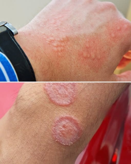 When a Skin Rash Becomes a Warning Sign