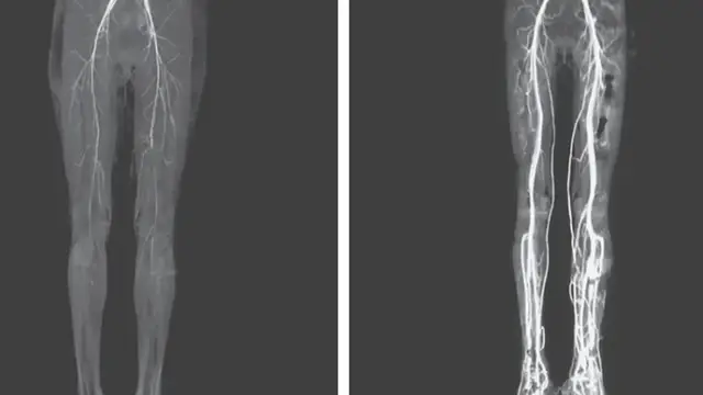 Woman’s Burning Leg Pain Led to Rare Disease Once Known as ‘Holy Fire’