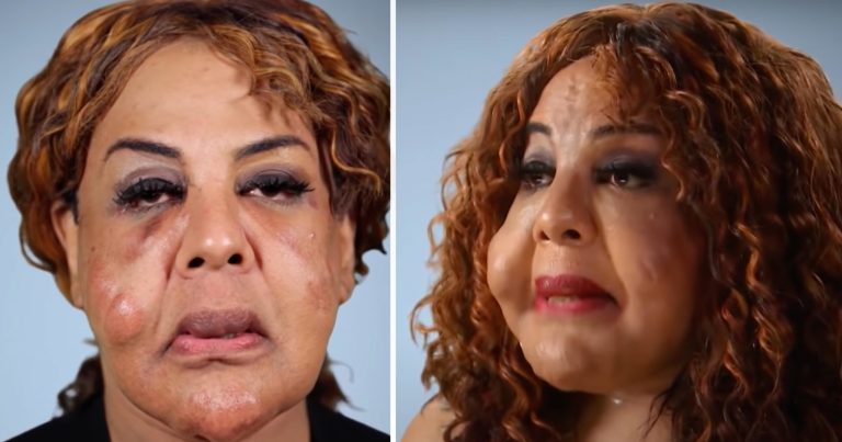 “Cement Face” woman 21 years later