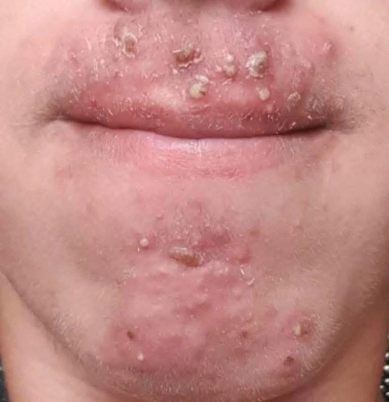 Mystery Bumps Around the Mouth