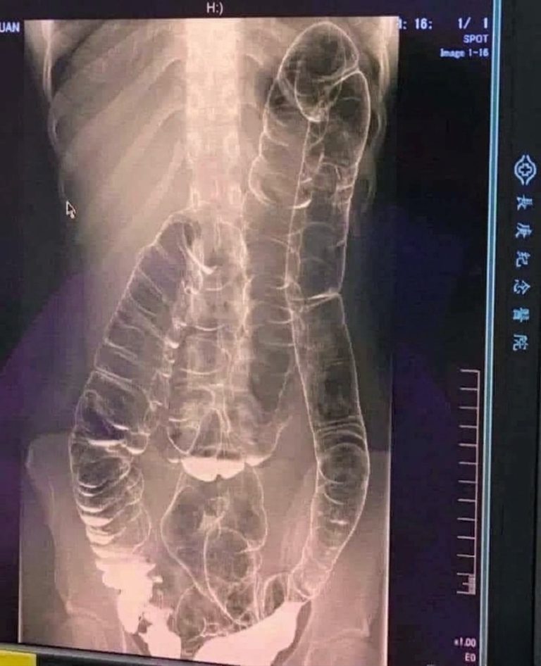 Severe Constipation and Toxic Megacolon Warning Signs