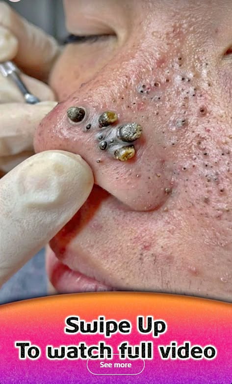 Why Acne on the Nose