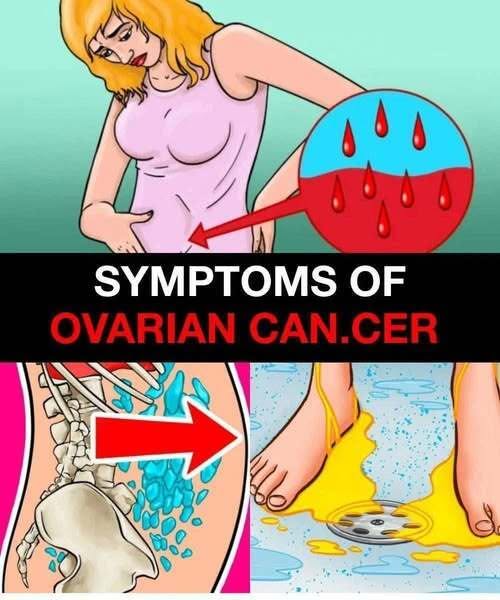 Ovarian Can.cer May Develop